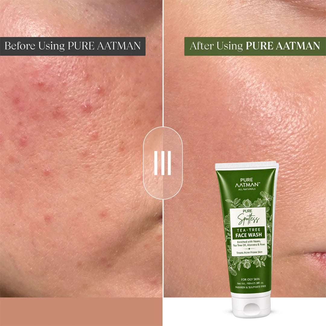 Tea Tree Oil & Aloevera Face Wash removes Oil, Acne & Pimples 100 ml - 100 ml