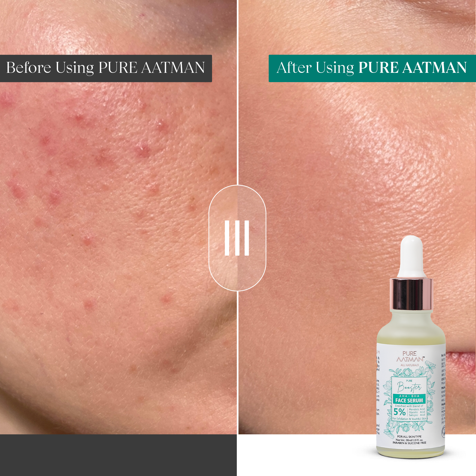 AHA & BHA Acne Solution for Face | Enrich with  5% OF MANDALIC ACID,  GLYCOLIC ACID, SALICYLIC ACID| Chemical peel for glowing face | Exfoliating serum|30ml | Suitable for all Skin type