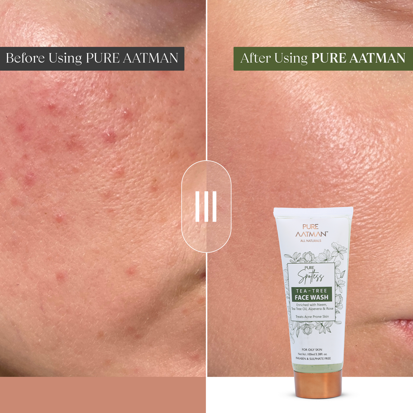 Tea Tree Oil & Aloevera Face Wash removes Oil, Acne & Pimples 100 ml - 100 ml