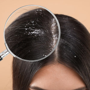 Dandruff
