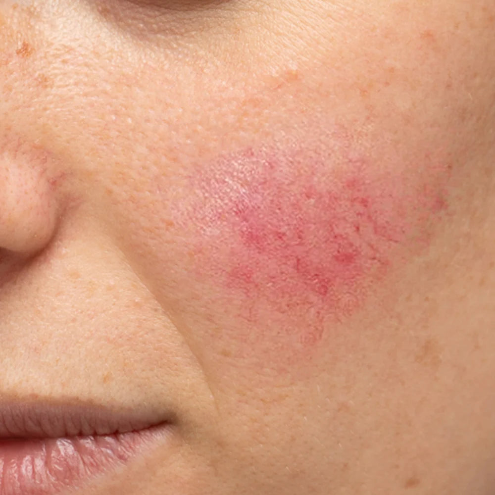 sensetive_skin.webp